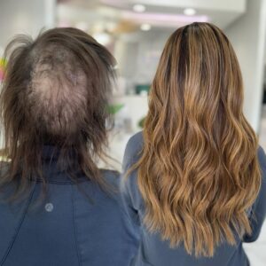 no shave topper for hair loss and thinning hair tampa specialist